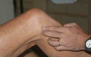 Травма мениска коленного сустава