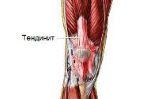 Воспаление сухожилий колена