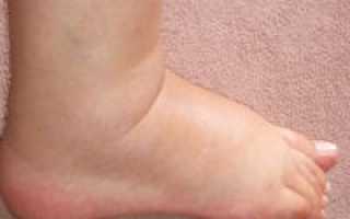 Отеки ног в области щиколотки у женщин
