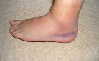 Как лечить отек стопы на ноге после травмы