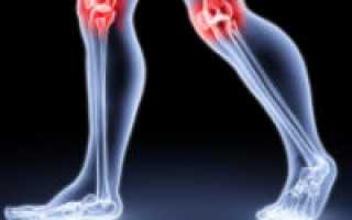 Какие лекарства применяют при артрите коленного сустава