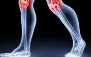 Какие существуют заболевания коленного сустава