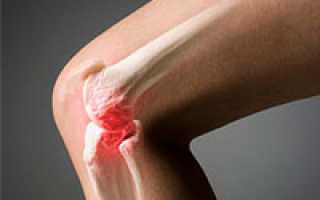 Лекарства от артроза коленного сустава