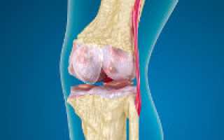 Что такое остеофиты коленного сустава