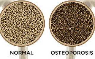 Постменопаузальный остеопороз