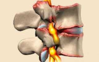 Остеофиты позвоночника и их лечение