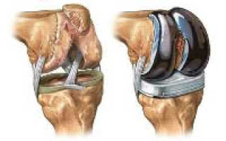 Операция по замене коленного сустава на эндопротез