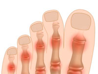воспаление суставов пальцев ног