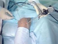Артроскопия колена