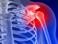 Остеоартроз плечевого сустава