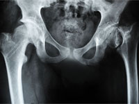 рентген тазобедренного сустава