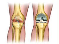 Эндопротезирование коленного сустава