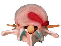 грыжа межпозвонкового диска