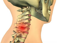 Повреждение шейных позвонков