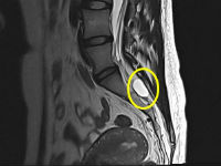 Киста позвоночника на МРТ