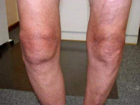 Деформация коленных суставов при остеоартрозе