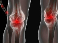 Артроз коленных суставов