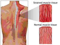 миозит мышц спины