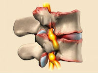Остеохондроз позвоночника