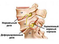 корешковый синдром