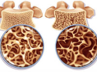 Остеопороз