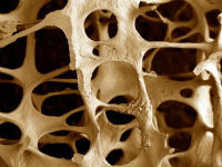 Структура кости при остеопорозе