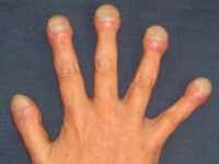 Пальцы с уплотненными ногтями