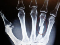 Рентген кисти руки, перелом