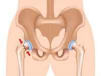 Перелом бедренной шейки