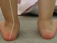 Детские кривые ножки