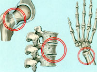 Поражение костей при остеопорозе