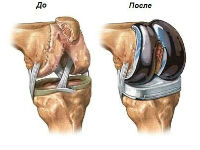 Металлический протез колена