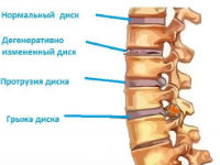 Протрузия межпозвоночного диска