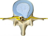 Протрузия межпозвоночного диска