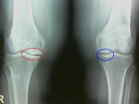 Субхондральный остеосклероз коленного сустава