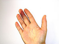 Ушиб пальца на руке