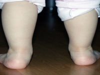 Кривые детские ножки